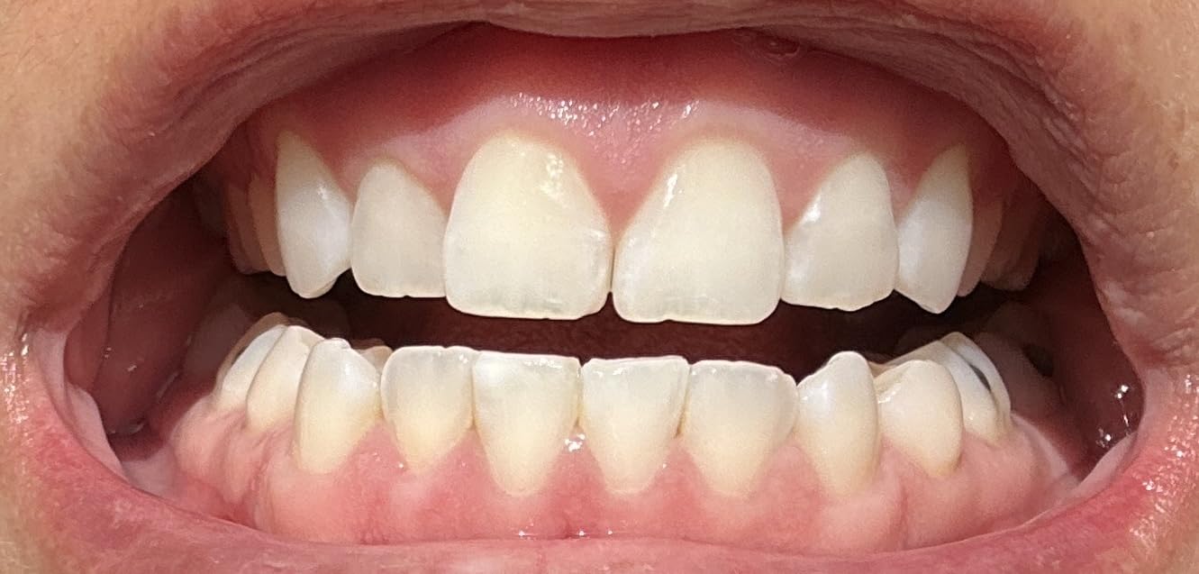 Opalescence Go 15- Prefilled Teeth Whitening Trays - 15% Hydrogen Peroxide - (10 Treatments) Made by Ultradent Products. Teeth Whitening Kit -Mint - 5194-1 customer photo 1