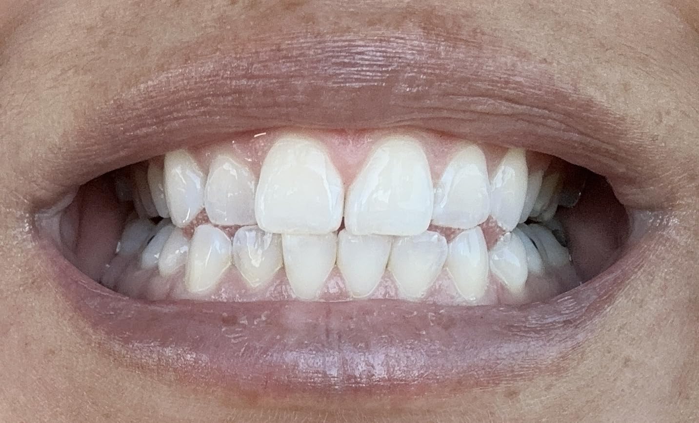 Opalescence Go 15- Prefilled Teeth Whitening Trays - 15% Hydrogen Peroxide - (10 Treatments) Made by Ultradent Products. Teeth Whitening Kit -Mint - 5194-1 customer photo 2