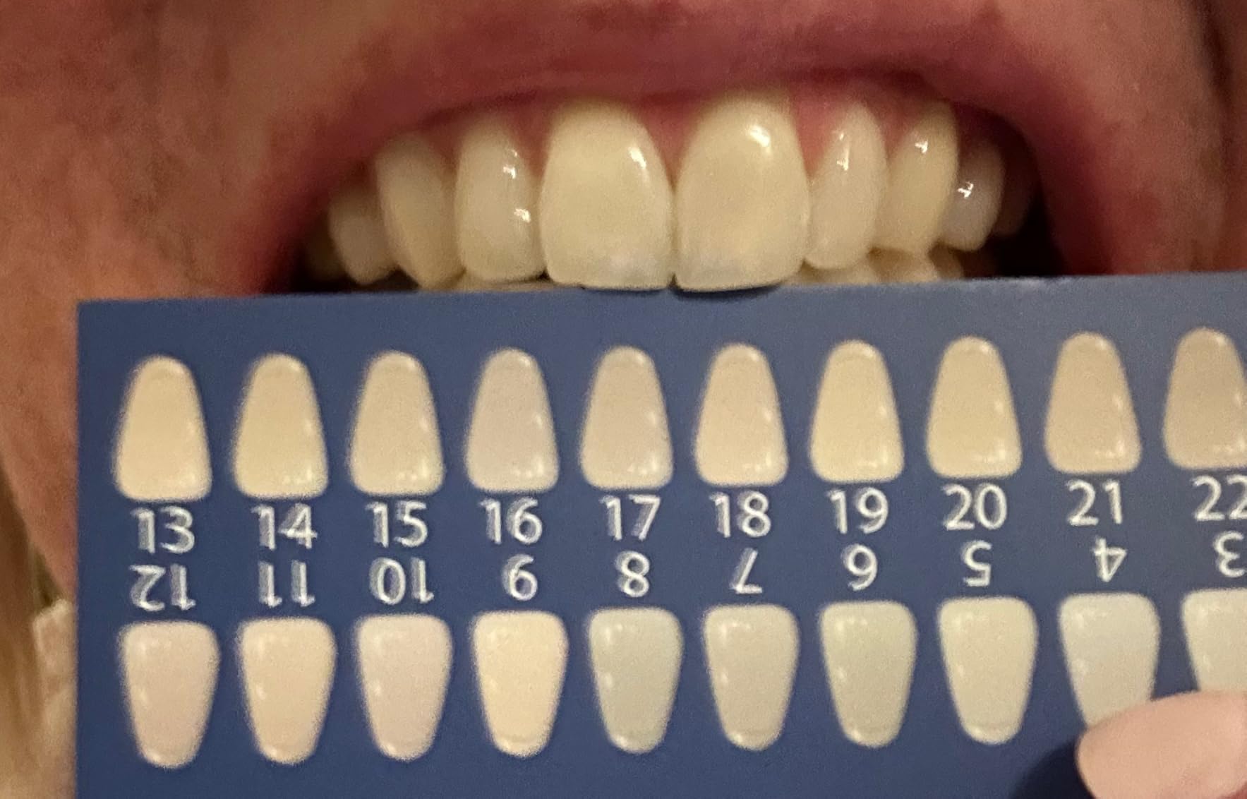 iSmile Teeth Whitening Kit - LED Light, 35% Carbamide Peroxide, (3) 3ml Gel Syringes, (1) Remineralization Gel, and Tray customer photo 1