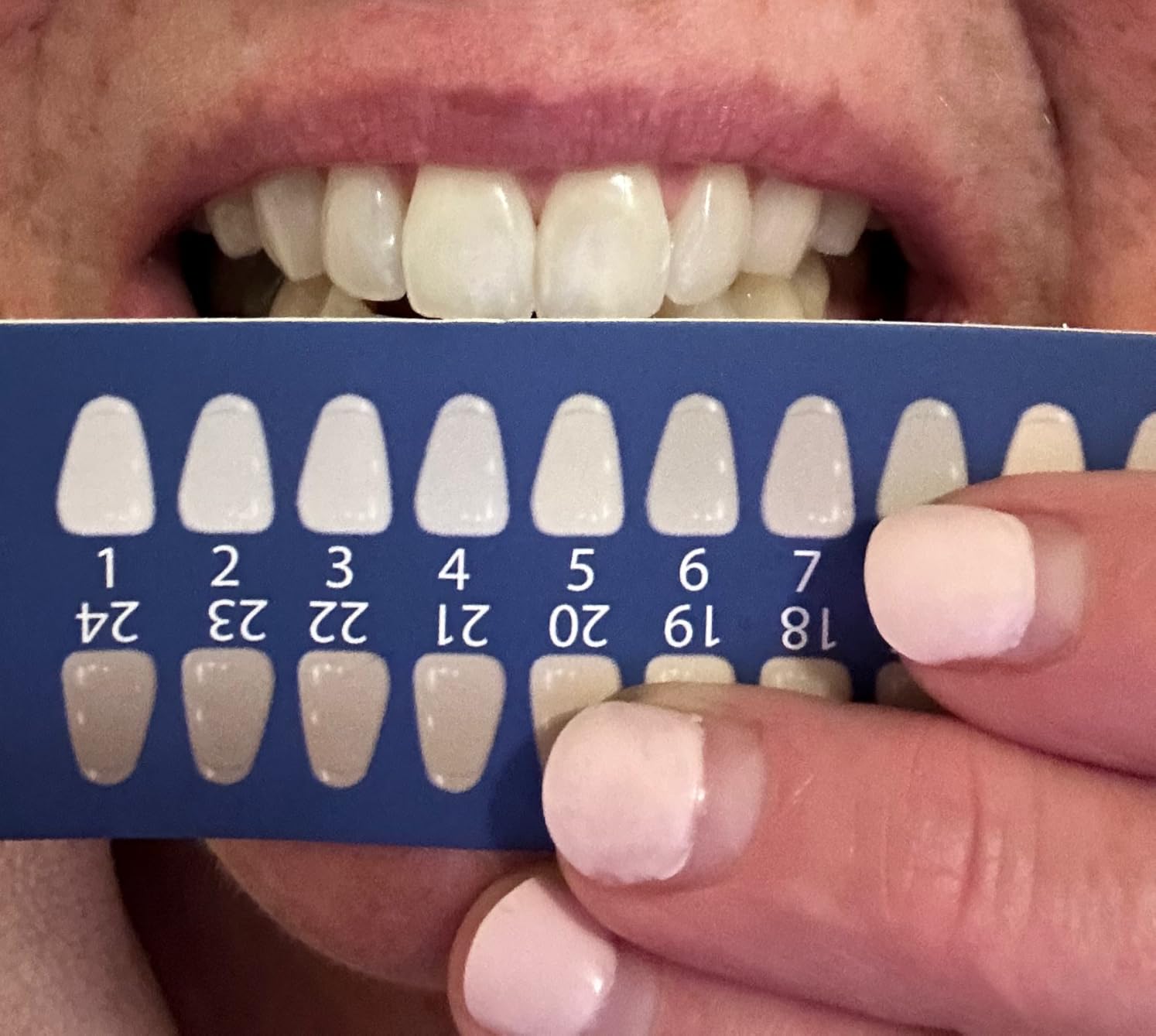iSmile Teeth Whitening Kit - LED Light, 35% Carbamide Peroxide, (3) 3ml Gel Syringes, (1) Remineralization Gel, and Tray customer photo 2