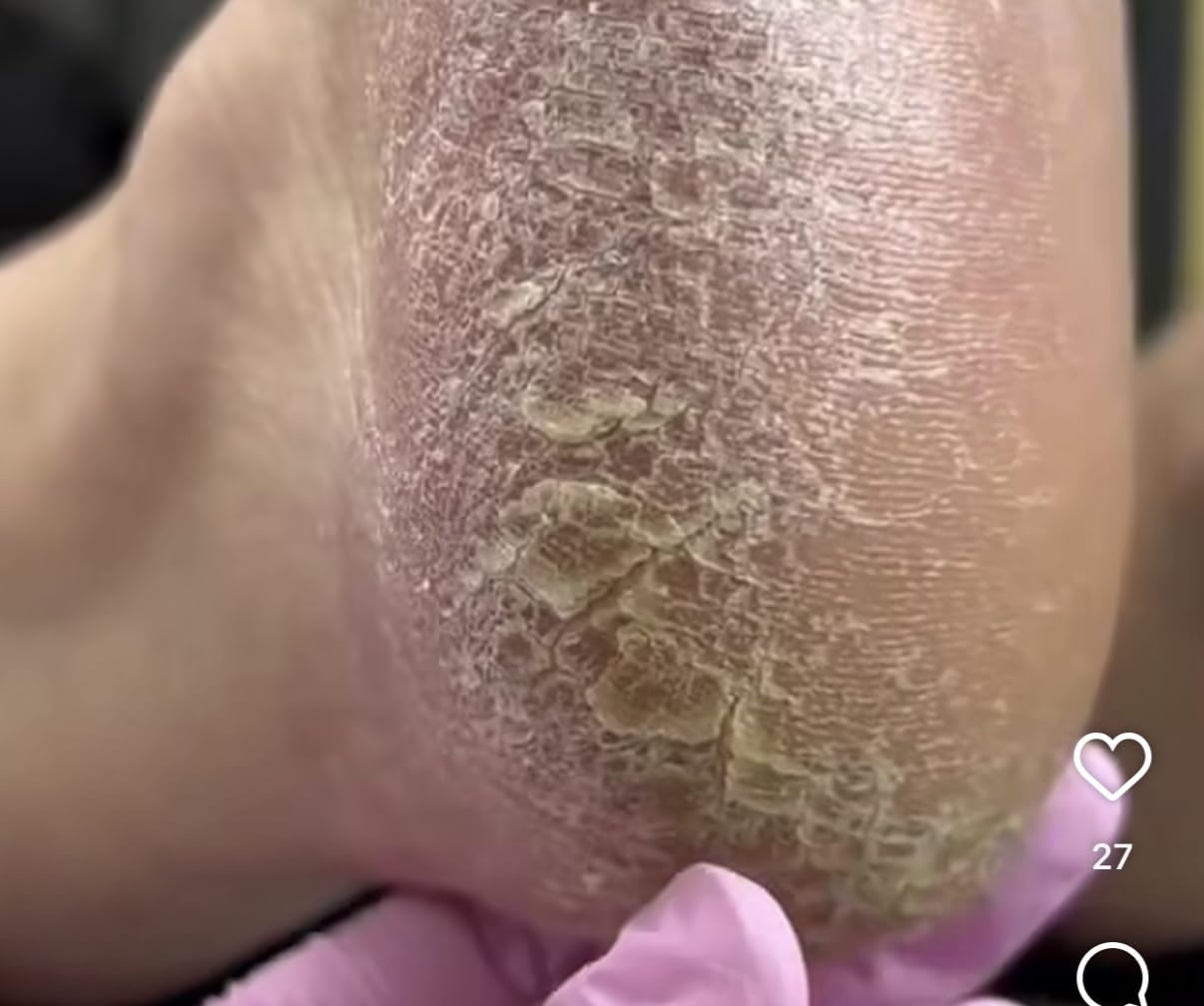 Callus Remover for Feet (Extra Strength) Foot Callus Remover Gel - Pedicure Tools for Feet Scrubber - Foot Care Spa Essentials, 6oz customer photo 2