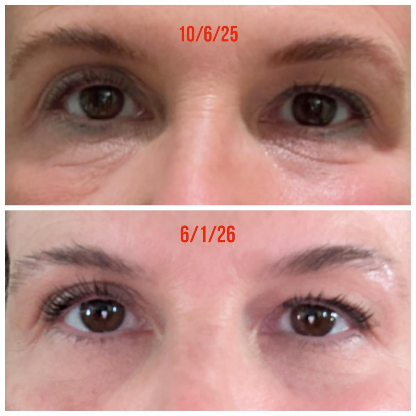 CeraVe Skin Renewing Eye Cream for Wrinkles, Under Eye Cream With Peptides + Caffeine + Niacinamide, Paraben Free & Ophthalmologist Tested customer photo 1