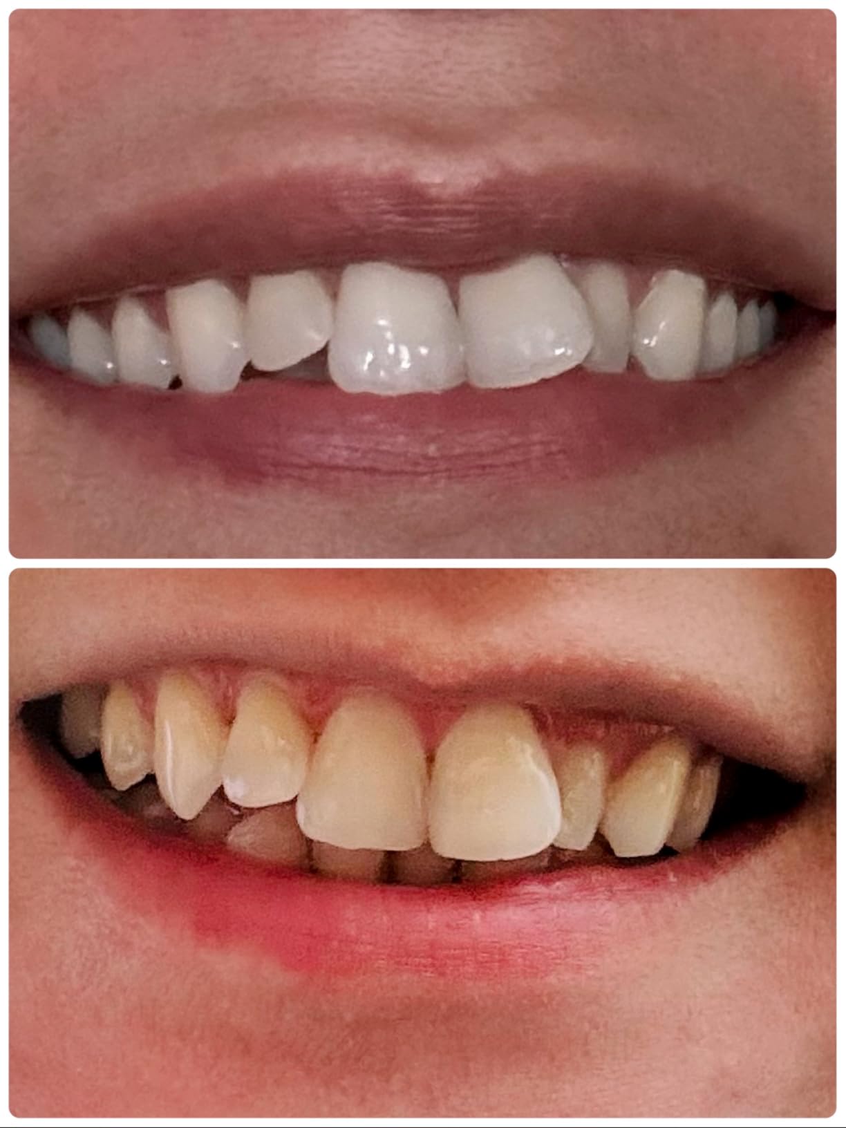 Pdoo Teeth Whitening Kit with LED Light for Sensitive Teeth, Fast Results for Brightening at Home, Teeth Whitening Gel Helps Remove All Kinds of Stains customer photo 2