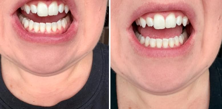 Professional Teeth Whitening Kit with 5 Teeth Whitening Gel customer photo 1